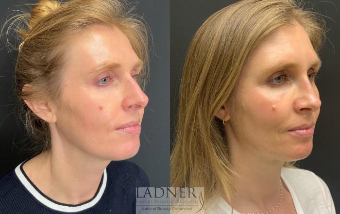 Rhinoplasty (Nose job) Case 181 Before & After Right Oblique | Denver, CO | Ladner Facial Plastic Surgery