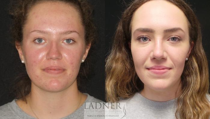 Rhinoplasty (Nose job) Case 182 Before & After Front | Denver, CO | Ladner Facial Plastic Surgery