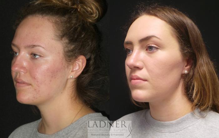 Rhinoplasty (Nose job) Case 182 Before & After Left Oblique | Denver, CO | Ladner Facial Plastic Surgery