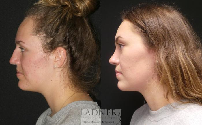 Rhinoplasty (Nose job) Case 182 Before & After Left Side | Denver, CO | Ladner Facial Plastic Surgery