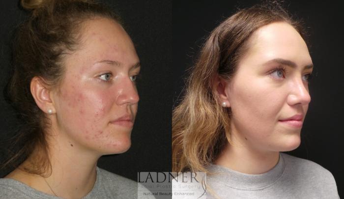Rhinoplasty (Nose job) Case 182 Before & After Right Oblique | Denver, CO | Ladner Facial Plastic Surgery