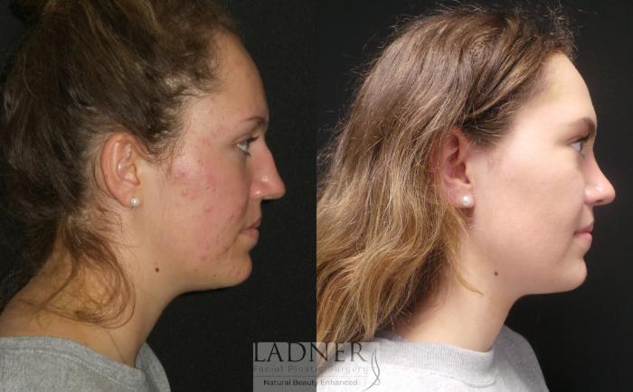 Rhinoplasty (Nose job) Case 182 Before & After Right Side | Denver, CO | Ladner Facial Plastic Surgery