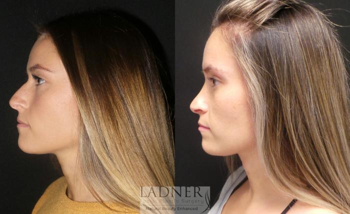 Rhinoplasty (Nose job) Case 184 Before & After Left Side | Denver, CO | Ladner Facial Plastic Surgery