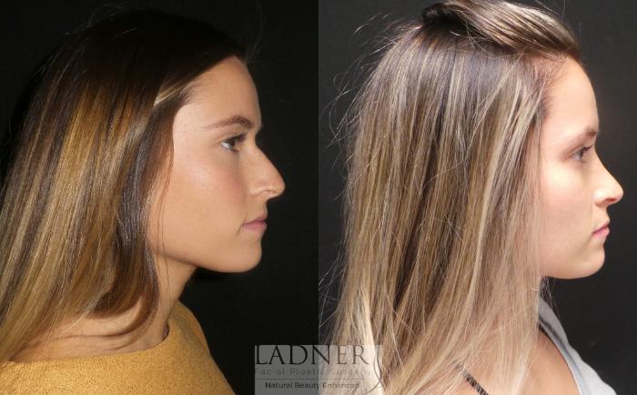 Rhinoplasty (Nose job) Case 184 Before & After Right Side | Denver, CO | Ladner Facial Plastic Surgery