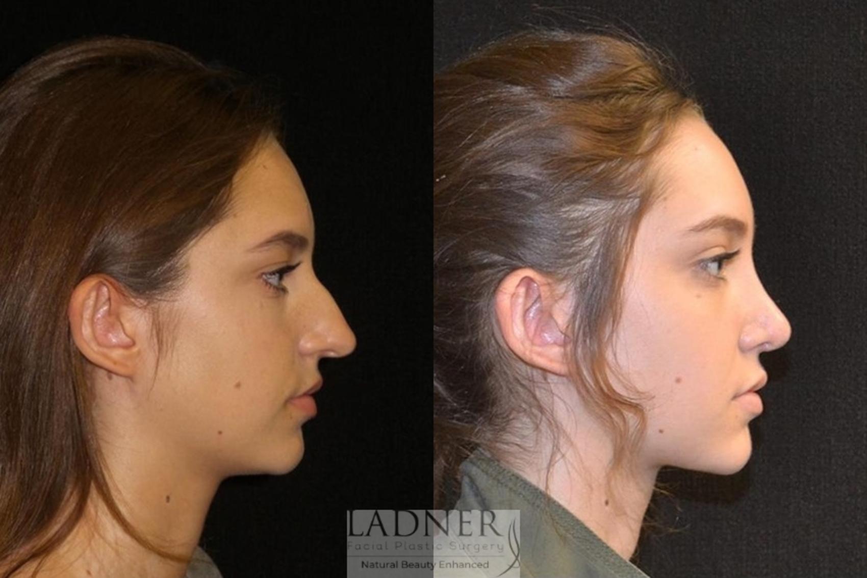 Rhinoplasty (Nose job) Case 19 Before & After Right Side | Denver, CO | Ladner Facial Plastic Surgery