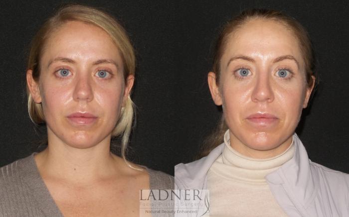Rhinoplasty (Nose job) Case 190 Before & After Front | Denver, CO | Ladner Facial Plastic Surgery