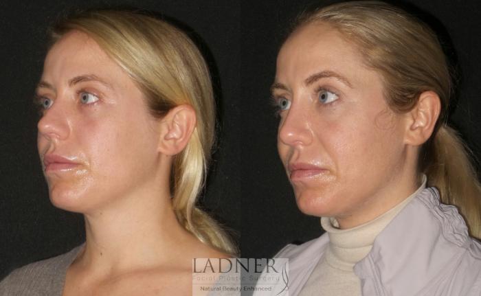 Rhinoplasty (Nose job) Case 190 Before & After Left Oblique | Denver, CO | Ladner Facial Plastic Surgery