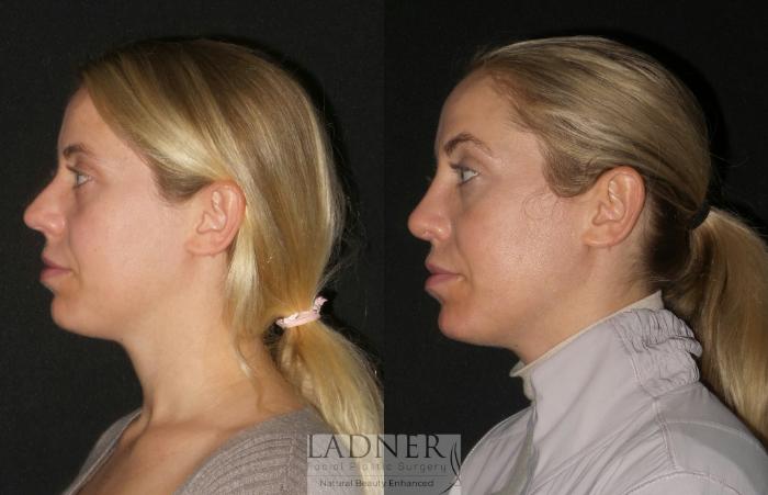 Rhinoplasty (Nose job) Case 190 Before & After Left Side | Denver, CO | Ladner Facial Plastic Surgery