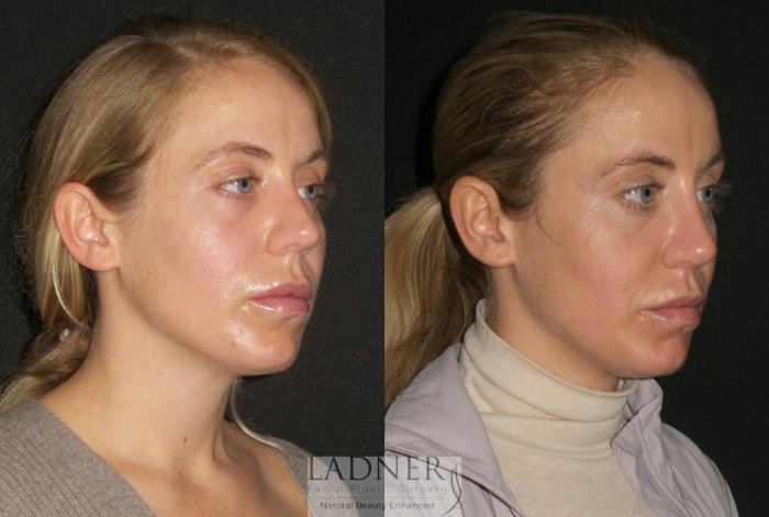 Rhinoplasty (Nose job) Case 190 Before & After Right Oblique | Denver, CO | Ladner Facial Plastic Surgery