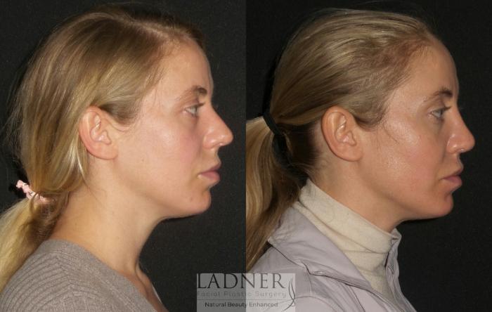 Rhinoplasty (Nose job) Case 190 Before & After Right Side | Denver, CO | Ladner Facial Plastic Surgery