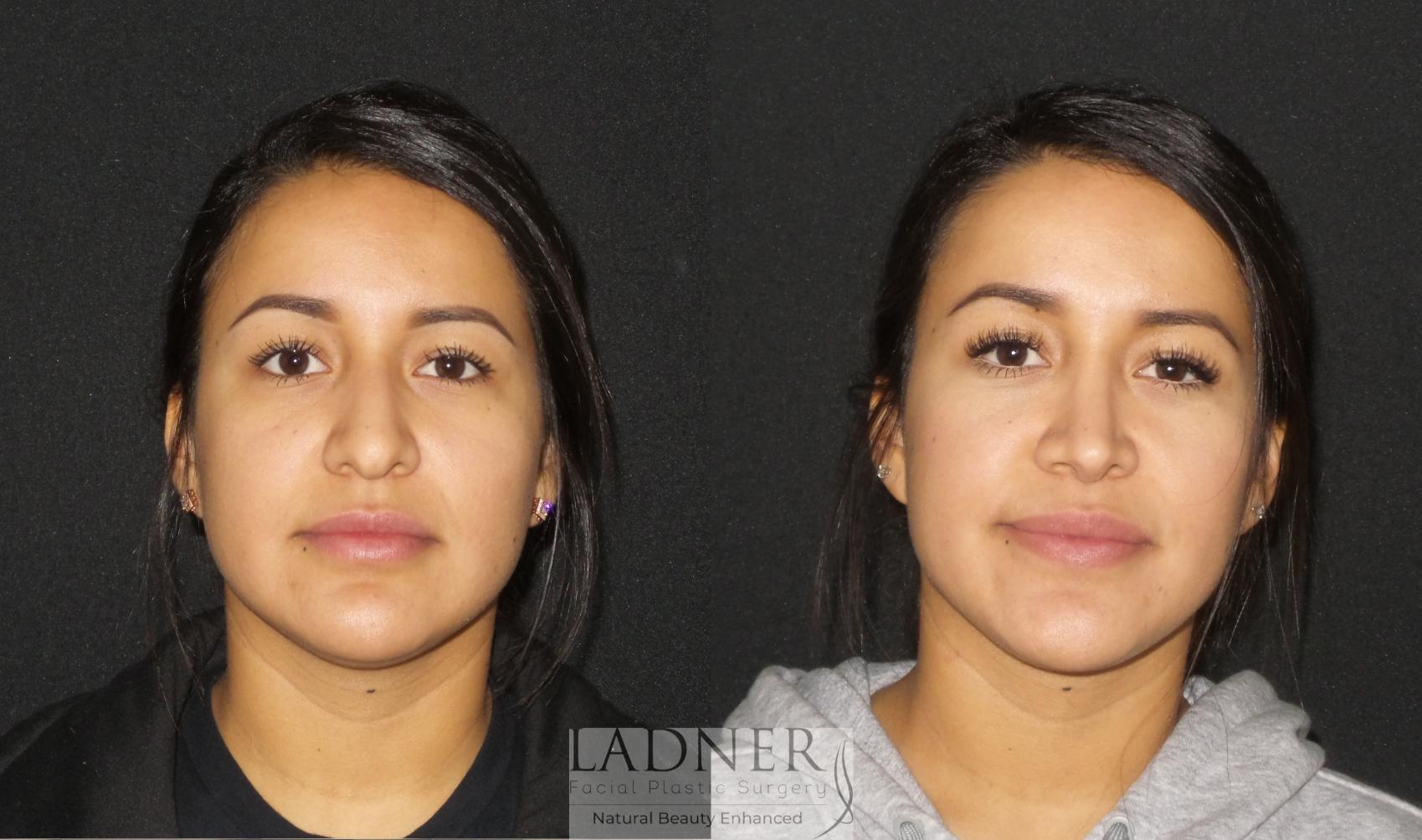 Rhinoplasty (Nose job) Case 192 Before & After Front | Denver, CO | Ladner Facial Plastic Surgery