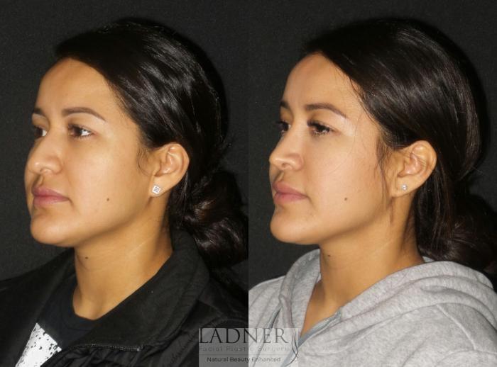 Rhinoplasty (Nose job) Case 192 Before & After Left Oblique | Denver, CO | Ladner Facial Plastic Surgery