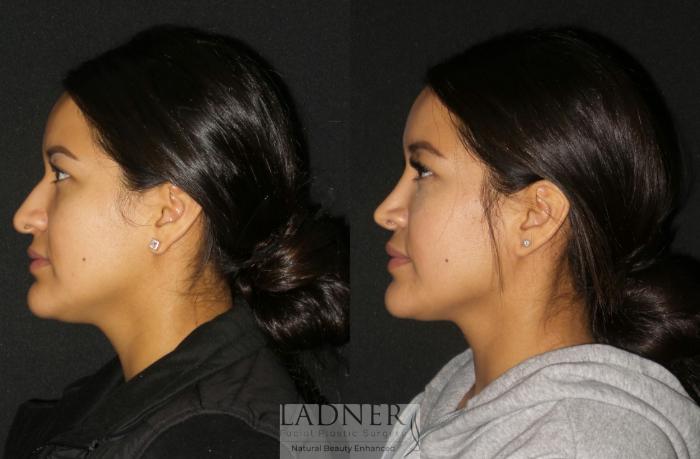 Rhinoplasty (Nose job) Case 192 Before & After Left Side | Denver, CO | Ladner Facial Plastic Surgery