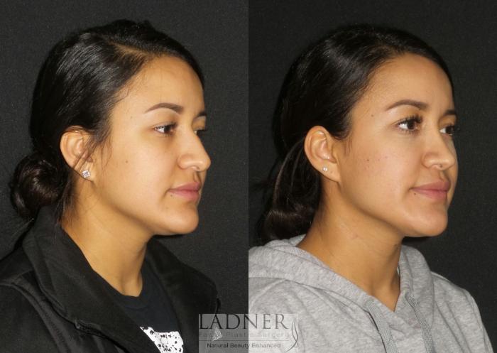 Rhinoplasty (Nose job) Case 192 Before & After Right Oblique | Denver, CO | Ladner Facial Plastic Surgery
