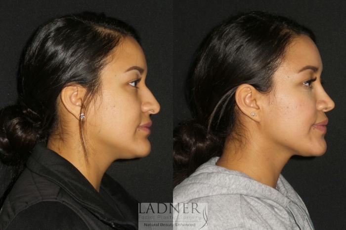 Rhinoplasty (Nose job) Case 192 Before & After Right Side | Denver, CO | Ladner Facial Plastic Surgery