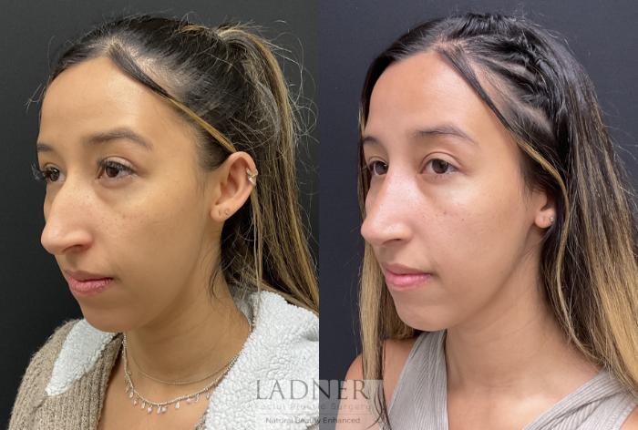 Rhinoplasty (Nose job) Case 194 Before & After Left Oblique | Denver, CO | Ladner Facial Plastic Surgery