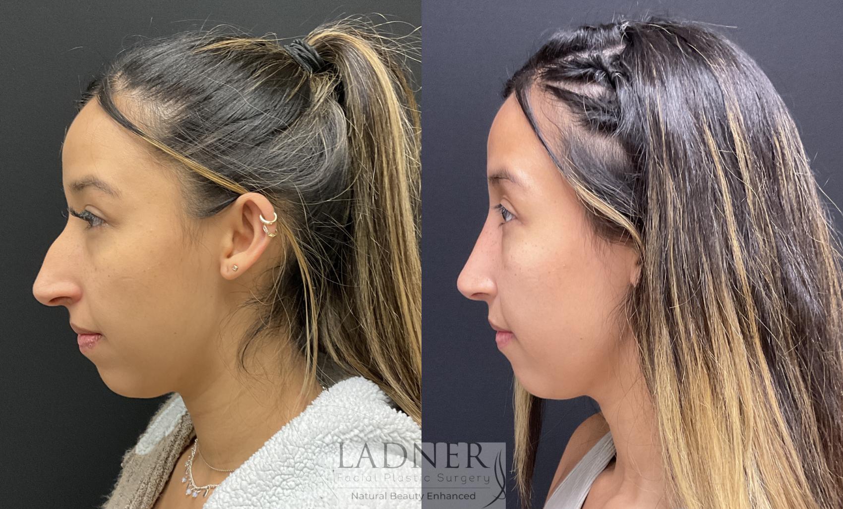 Rhinoplasty (Nose job) Case 194 Before & After Left Side | Denver, CO | Ladner Facial Plastic Surgery