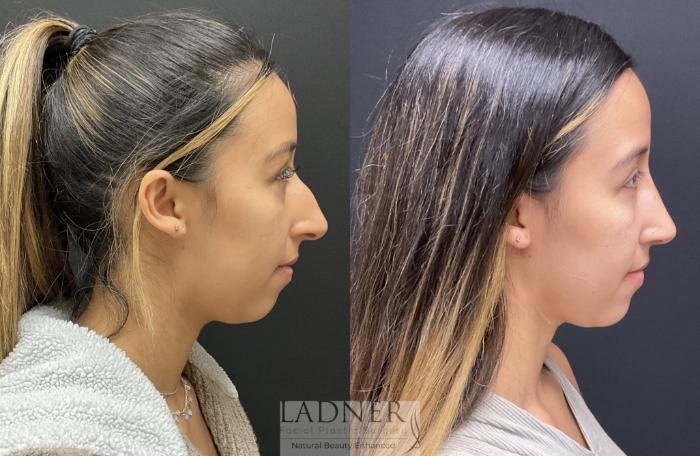 Rhinoplasty (Nose job) Case 194 Before & After Right Side | Denver, CO | Ladner Facial Plastic Surgery