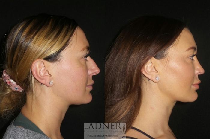 Rhinoplasty (Nose job) Case 2 Before & After Right Side | Denver, CO | Ladner Facial Plastic Surgery