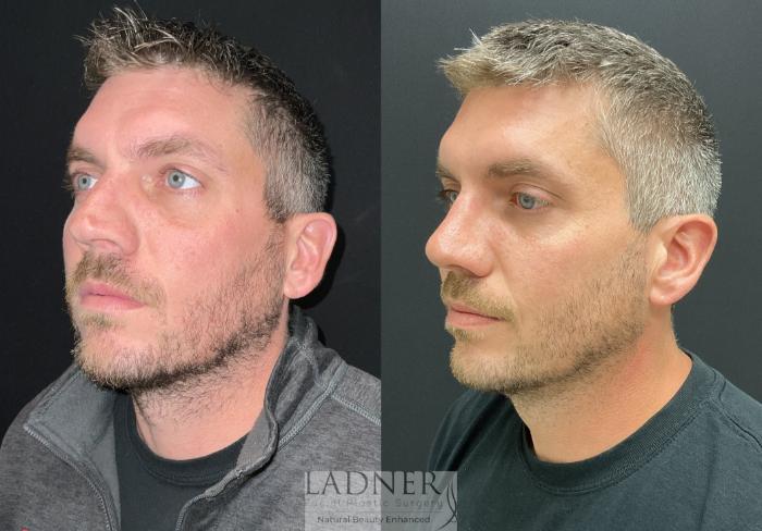Rhinoplasty (Nose job) Case 204 Before & After Left Oblique | Denver, CO | Ladner Facial Plastic Surgery