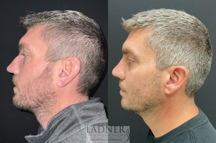 Rhinoplasty (Nose job) Case 204 Before & After Left Side | Denver, CO | Ladner Facial Plastic Surgery