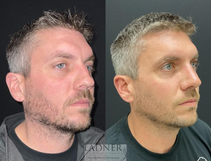 Rhinoplasty (Nose job) Case 204 Before & After Right Oblique | Denver, CO | Ladner Facial Plastic Surgery