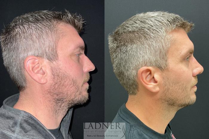 Rhinoplasty (Nose job) Case 204 Before & After Right Side | Denver, CO | Ladner Facial Plastic Surgery