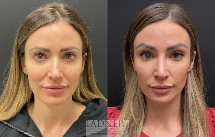 Rhinoplasty (Nose job) Case 207 Before & After Front | Denver, CO | Ladner Facial Plastic Surgery