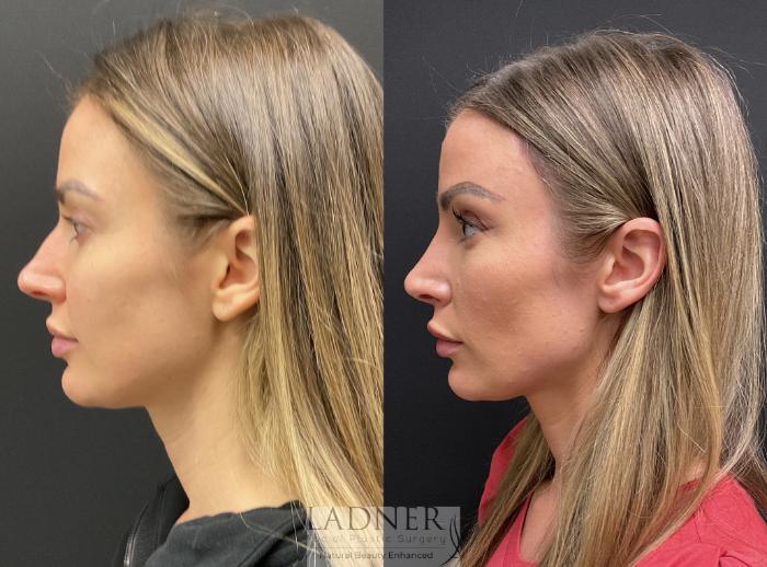 Rhinoplasty (Nose job) Case 207 Before & After Left Side | Denver, CO | Ladner Facial Plastic Surgery
