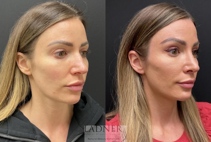 Rhinoplasty (Nose job) Case 207 Before & After Right Oblique | Denver, CO | Ladner Facial Plastic Surgery