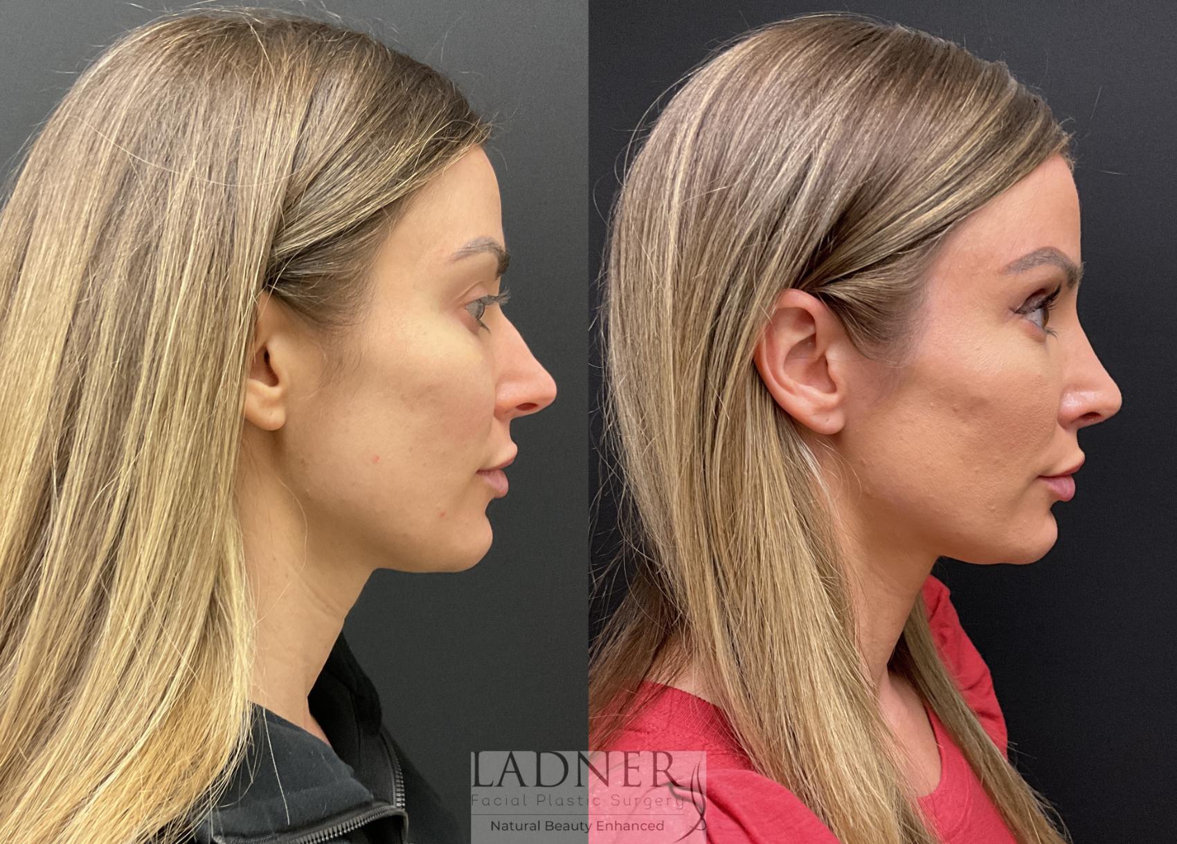 Rhinoplasty (Nose job) Case 207 Before & After Right Side | Denver, CO | Ladner Facial Plastic Surgery