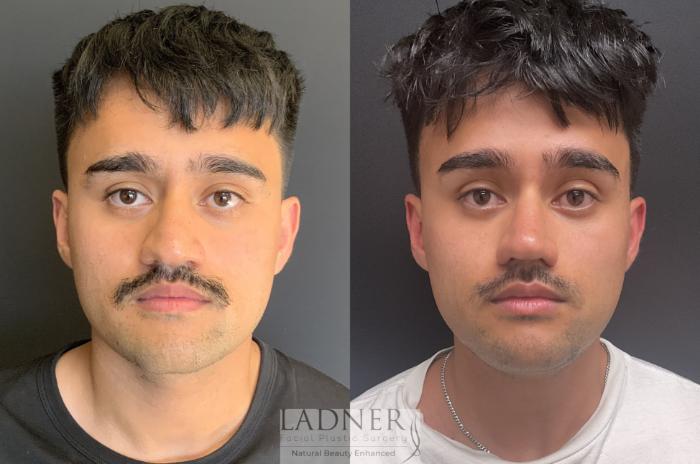 Rhinoplasty (Nose job) Case 213 Before & After Front | Denver, CO | Ladner Facial Plastic Surgery