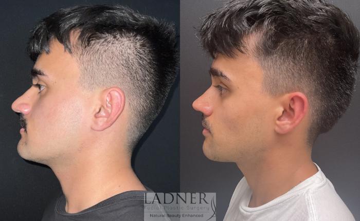 Rhinoplasty (Nose job) Case 213 Before & After Left Side | Denver, CO | Ladner Facial Plastic Surgery