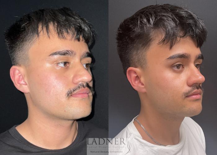 Rhinoplasty (Nose job) Case 213 Before & After Right Oblique | Denver, CO | Ladner Facial Plastic Surgery