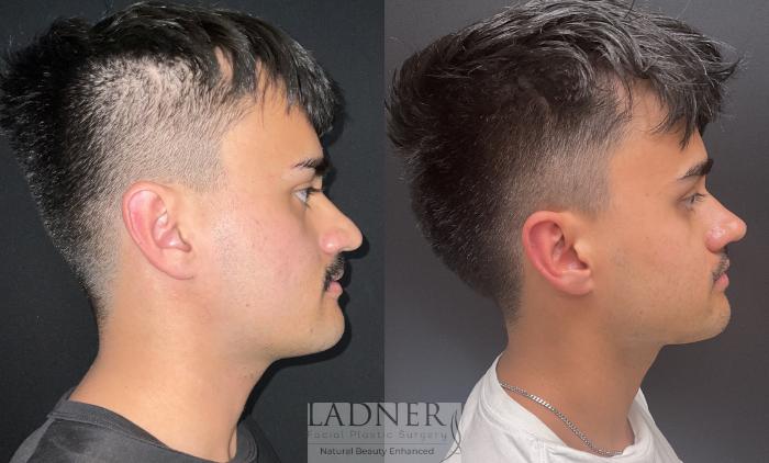 Rhinoplasty (Nose job) Case 213 Before & After Right Side | Denver, CO | Ladner Facial Plastic Surgery