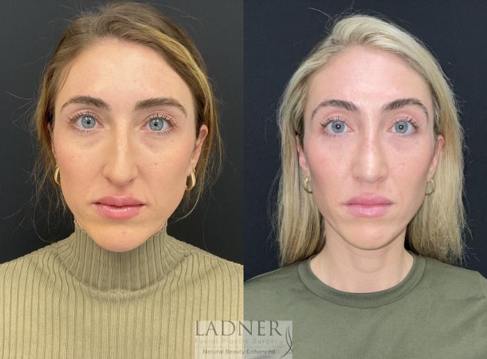 Rhinoplasty (Nose job) Case 218 Before & After Front | Denver, CO | Ladner Facial Plastic Surgery