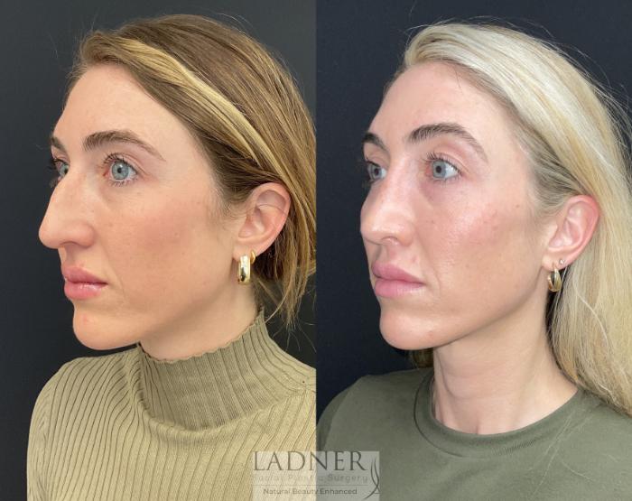 Rhinoplasty (Nose job) Case 218 Before & After Left Oblique | Denver, CO | Ladner Facial Plastic Surgery