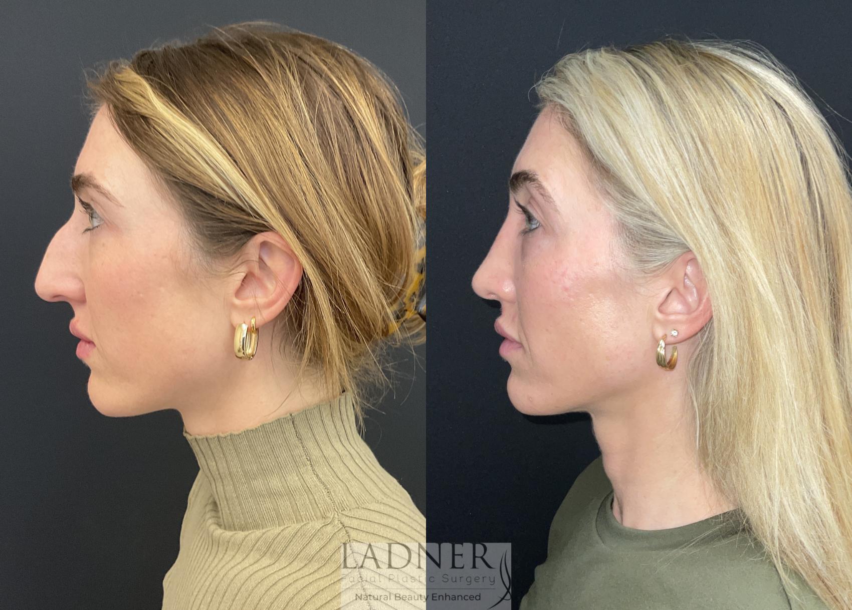 Rhinoplasty (Nose job) Case 218 Before & After Left Side | Denver, CO | Ladner Facial Plastic Surgery