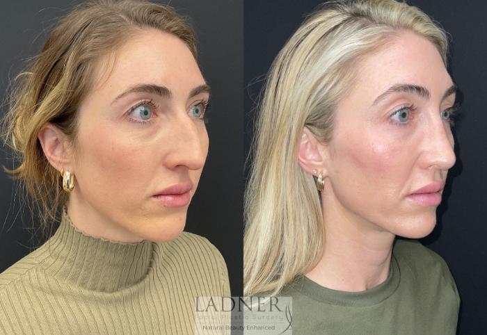 Rhinoplasty (Nose job) Case 218 Before & After Right Oblique | Denver, CO | Ladner Facial Plastic Surgery
