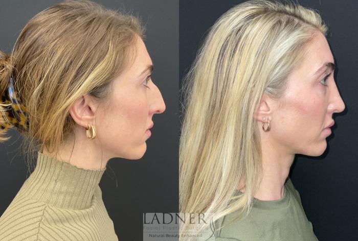 Rhinoplasty (Nose job) Case 218 Before & After Right Side | Denver, CO | Ladner Facial Plastic Surgery