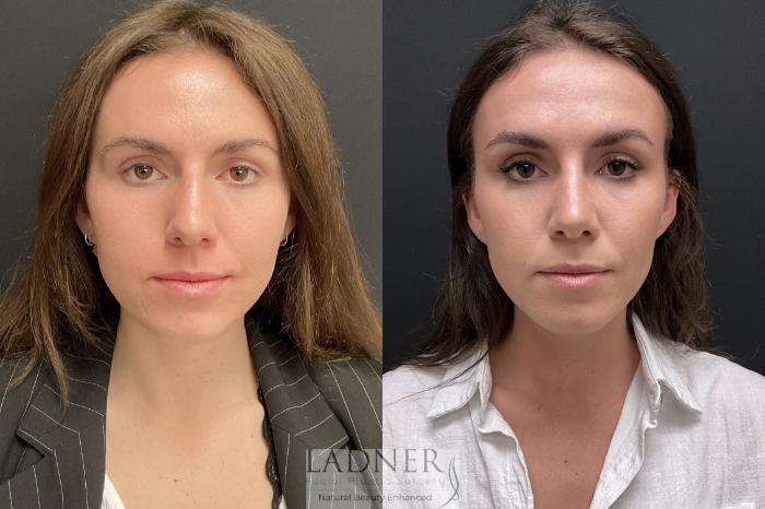 Rhinoplasty (Nose job) Case 219 Before & After Front | Denver, CO | Ladner Facial Plastic Surgery