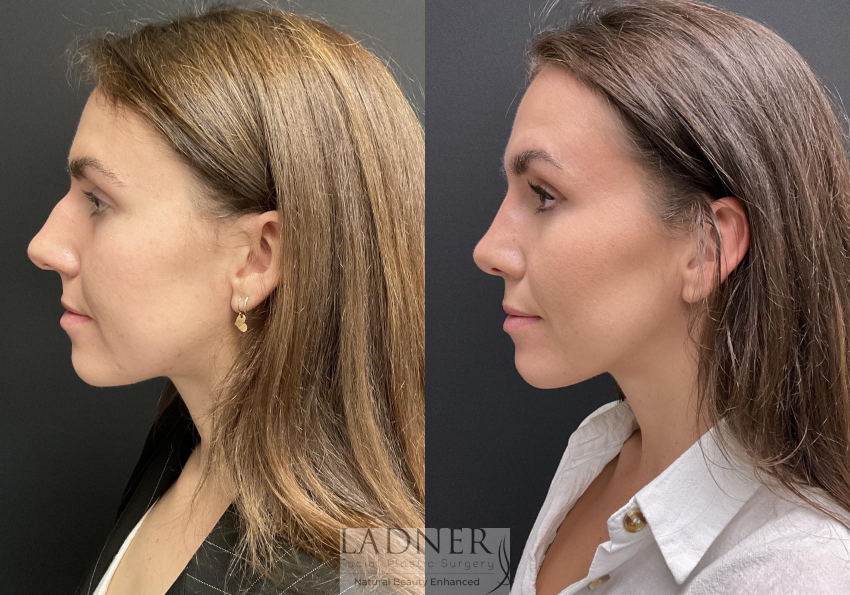 Rhinoplasty (Nose job) Case 219 Before & After Left Side | Denver, CO | Ladner Facial Plastic Surgery