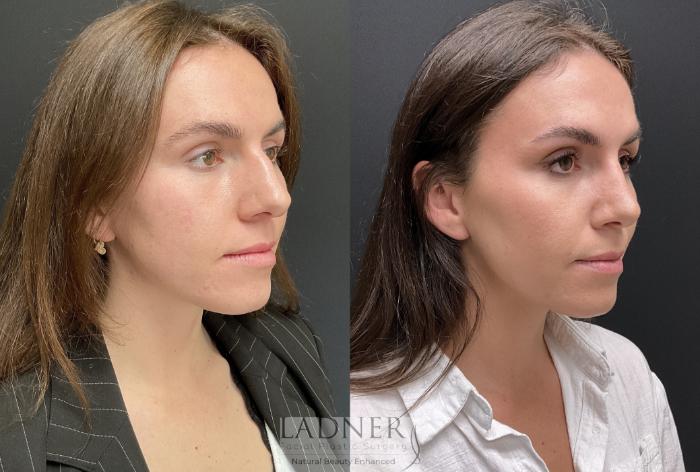 Rhinoplasty (Nose job) Case 219 Before & After Right Oblique | Denver, CO | Ladner Facial Plastic Surgery