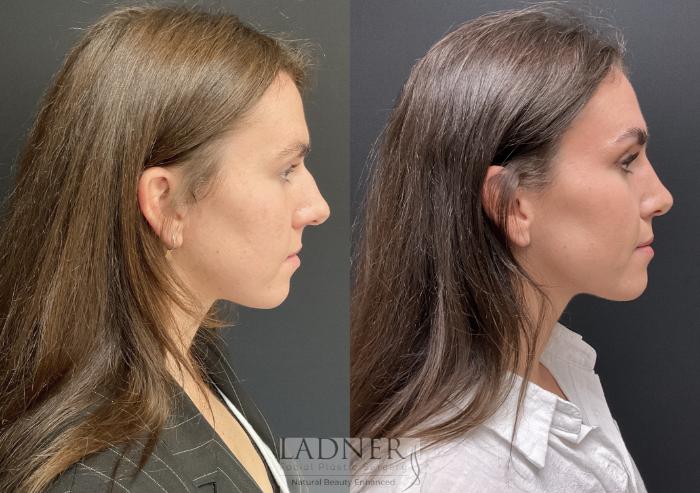 Rhinoplasty (Nose job) Case 219 Before & After Right Side | Denver, CO | Ladner Facial Plastic Surgery