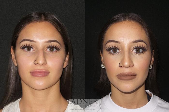 Rhinoplasty (Nose job) Case 3 Before & After Front | Denver, CO | Ladner Facial Plastic Surgery