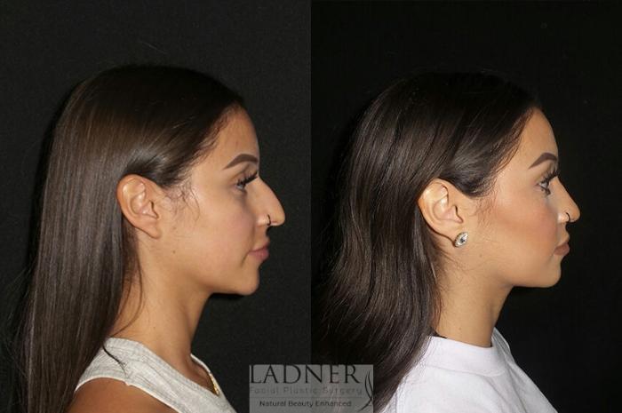 Rhinoplasty (Nose job) Case 3 Before & After Right Side | Denver, CO | Ladner Facial Plastic Surgery
