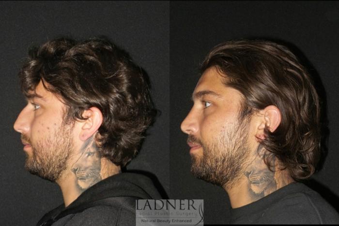 Facial Plastic Surgery for Men Case 4 Before & After Left Side | Denver, CO | Ladner Facial Plastic Surgery