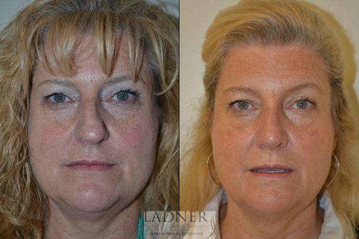 Rhinoplasty (Nose job) Case 41 Before & After Front | Denver, CO | Ladner Facial Plastic Surgery