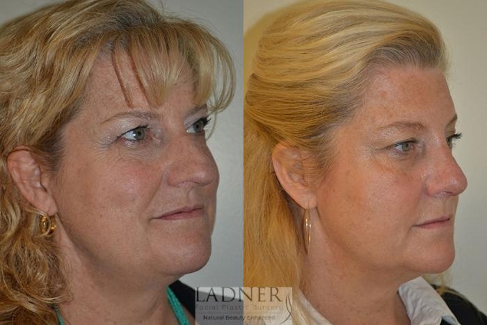 Rhinoplasty (Nose job) Case 41 Before & After Right Oblique | Denver, CO | Ladner Facial Plastic Surgery