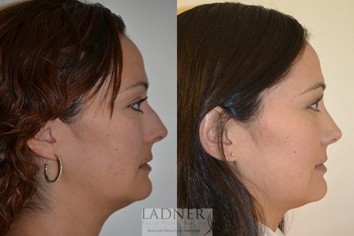 Rhinoplasty (Nose job) Case 42 Before & After Right Side | Denver, CO | Ladner Facial Plastic Surgery